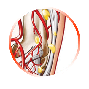 BREAK UP TENDON CALCIFICATION