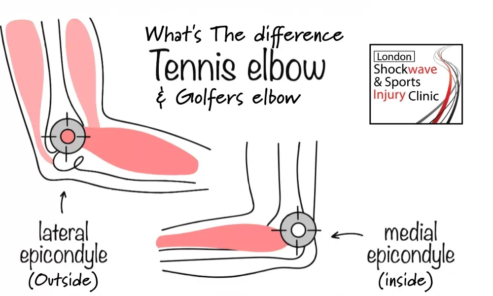 diffrences in tennis or golfers elbow treatment in wimbledon with shock wave therapy